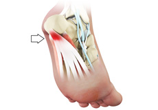 Plantar Fasciitis