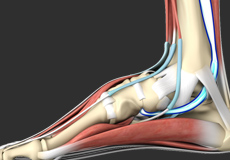 Posterior Tibial Tendon Dysfunction