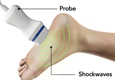 Shockwave Therapy