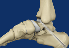 Subtalar Arthrodesis