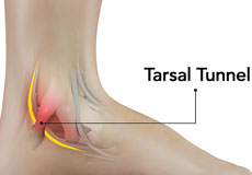 Tarsal Tunnel Syndrome